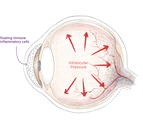 מידע על גלאוקומה אוביאטית מאת ד"ר דפנה חיים לנגפורד