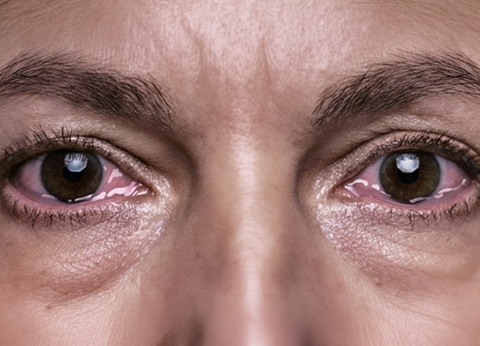 מחלת עיניים TED בבלוטת התריס: טיפולים, מחקר וכיצד לפעול