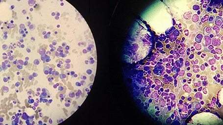 Resistant multiple myeloma cells (violet-blue) in two samples, seen under a microscope
