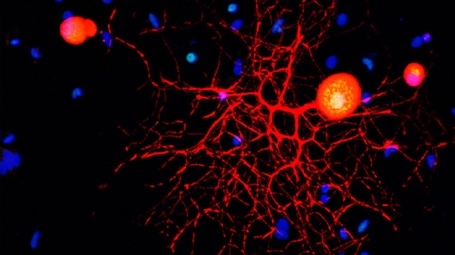 Confocal micrograph of a peripheral sensory neuron in culture. Marker stains and antibodies are used to identify neurons (red), c-Fos protein (green) and nuclei (blue). Note the nuclear localization of c-Fos