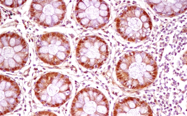 Cross-section of the inner lining of a human gut adjacent to a cancerous tumor. The enzyme ASL (red-brown), which helps manufacture nitric oxide, has accumulated in unusually high amounts in cells of the lining, probably in an attempt to alleviate the inflammation that commonly occurs in the gut of colon cancer patients