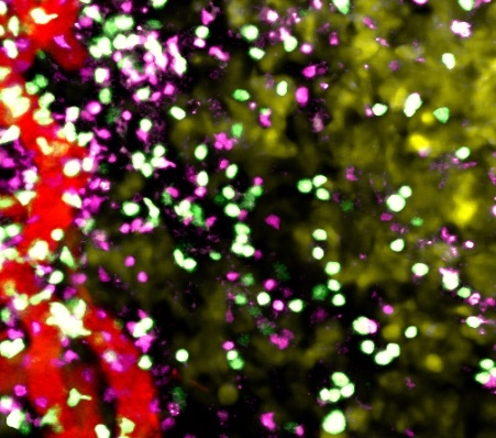Cancerous tumor tissue under a microscope: T cells grown under low oxygen conditions (green) and regular T cells (purple) show similar distribution patterns vis-à-vis blood vessels (red).