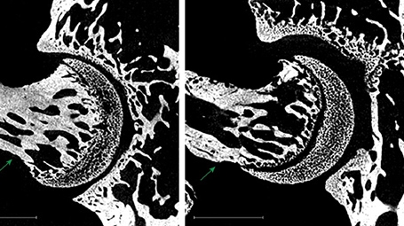 Micro-CT scans reveal that silencing the Piezo2 gene in proprioceptive neurons leads to distortions in the mouse hip joint (right) compared with the hip joint of intact mice (left)