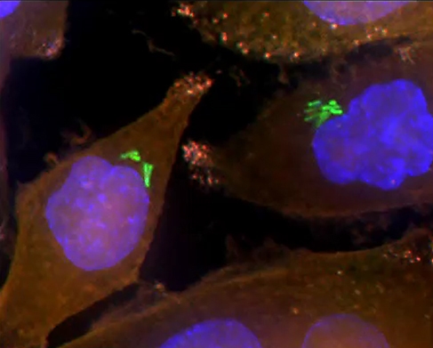 Bacteria (green) inside human pancreatic cancer cells (AsPC-1 cells). The cells’ nuclei are stained blue while their cytoplasm is stained orange