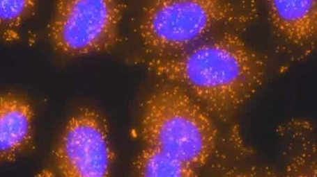 When the NXF1 gene functions properly, RNA molecules (orange dots) of a particular single-exon gene are exported from the nucleus (purple) into the cytoplasm