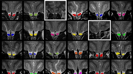 Computer-enhanced MRI images of the brains of left-handed women found two that were missing olfactory bulbs. Image: Eva Mishor and Ofer Perl