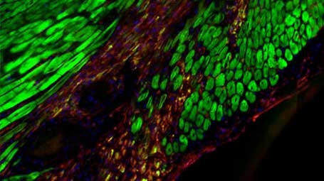 Injured heart following myocardial infarction. Healthy cardiomyocytes are stained in green. Injured area is stained in red